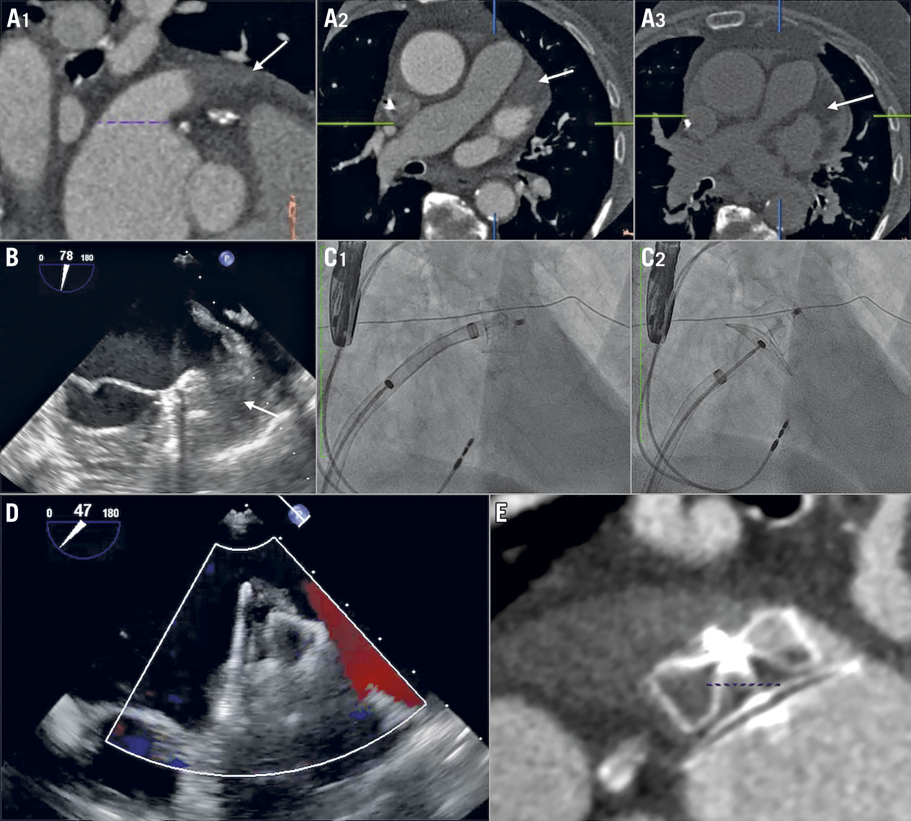 Left atrial appendage closure for thrombus trapping: the international ...