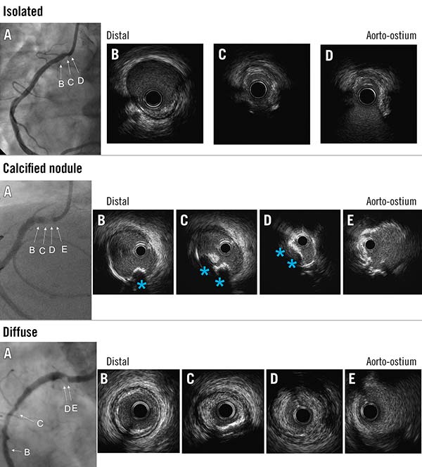 Ostial RCA lesions: outcomes after DES implantation