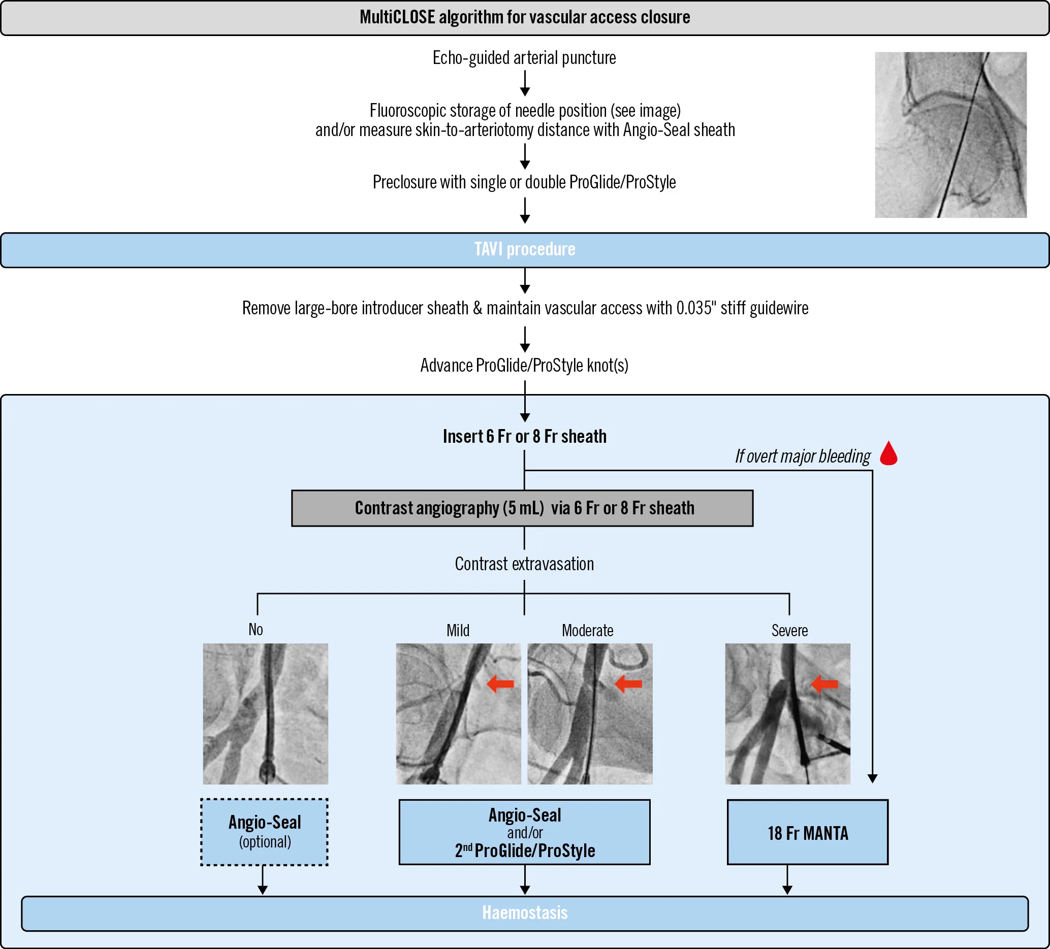 Vascular closure algorithm for TF-TAVI