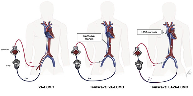 The latest on renal denervation, left ventricular recovery after TAVI, achieving complete revascularisation in ACS and more