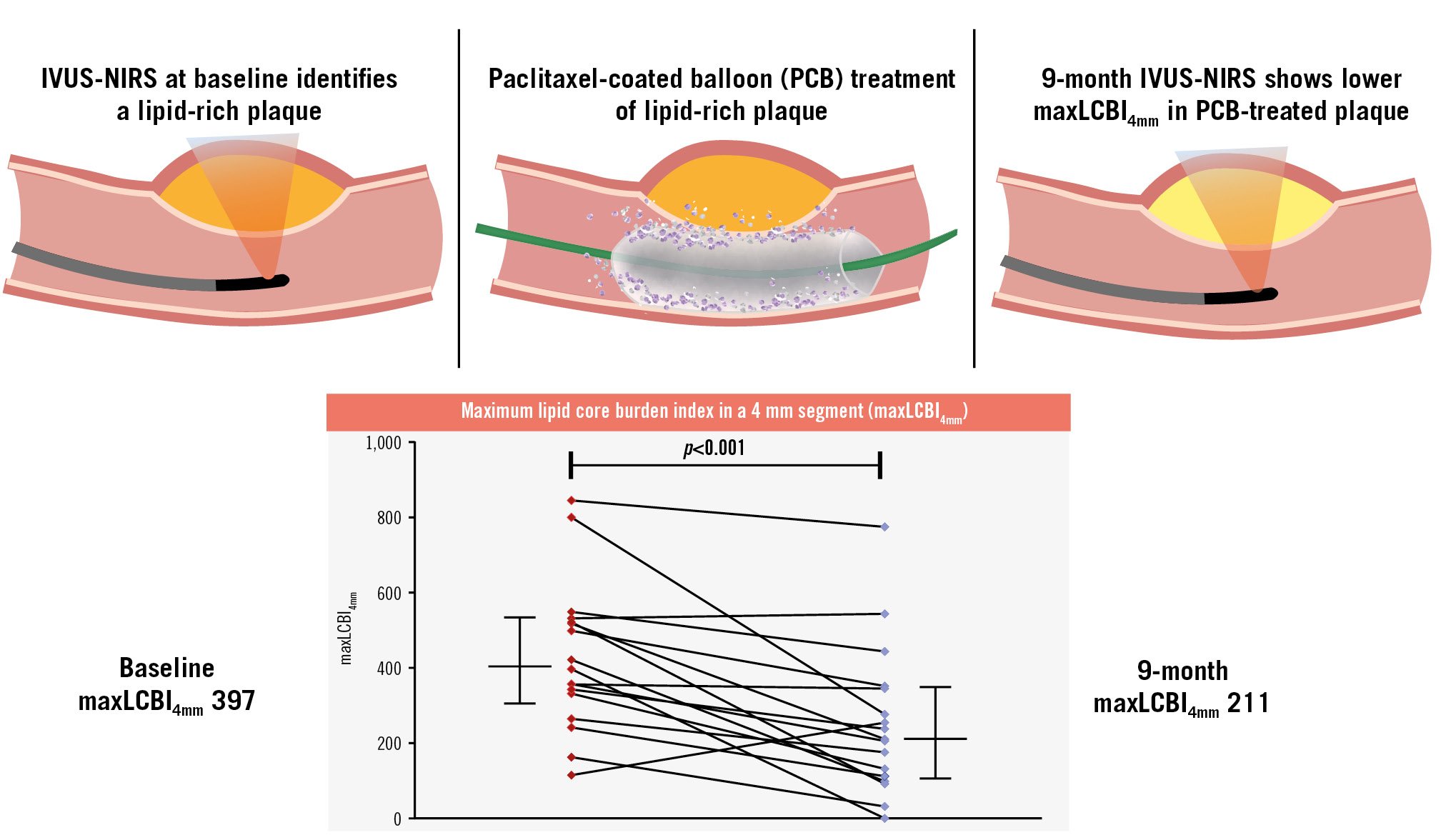 PCB for vulnerable lipid-rich plaques