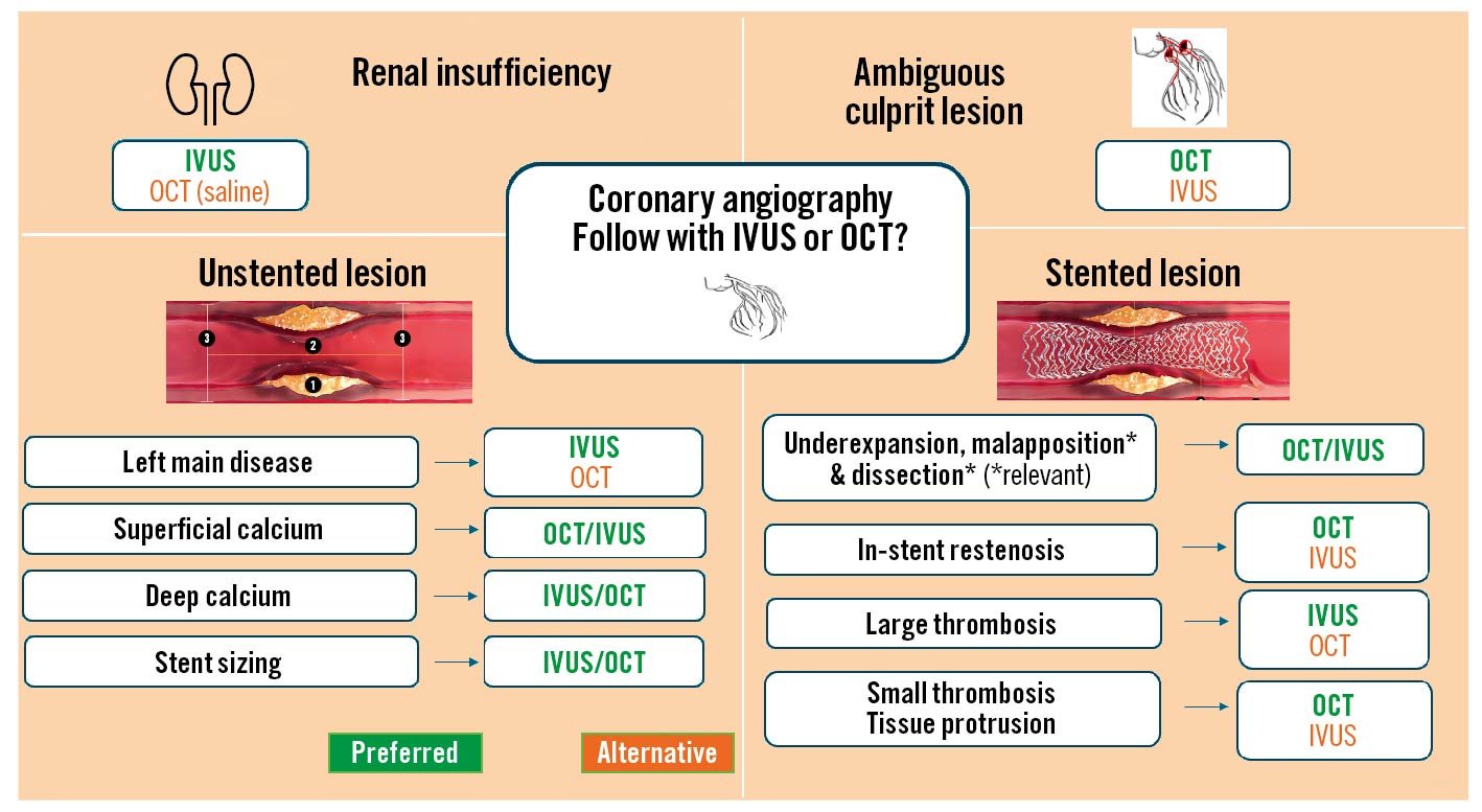 IVUS or OCT for PCI?