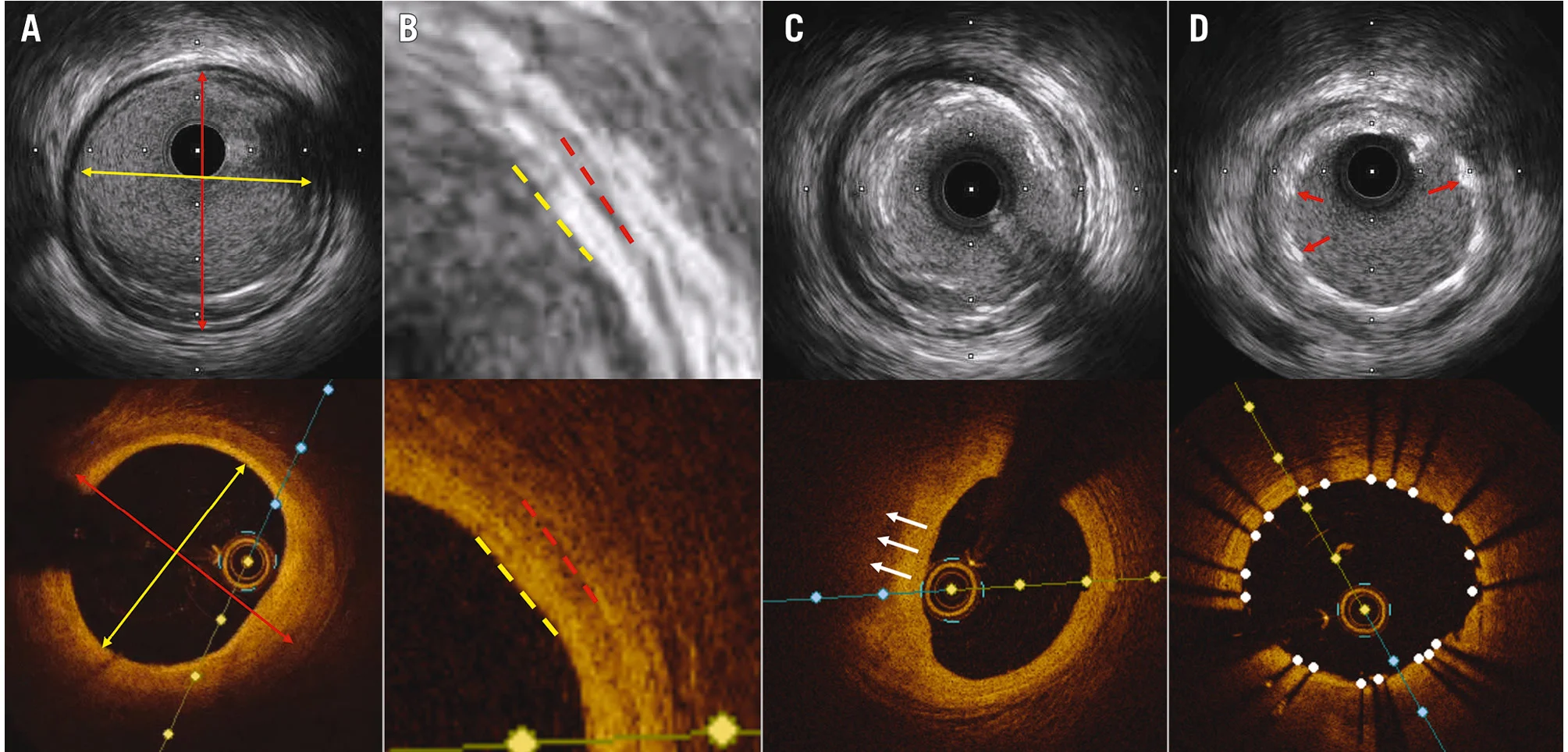 OCT-guided PCI