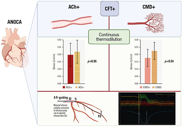 State-of-the-art on OCT-guided PCI; simplifying the continuous intracoronary thermodilution technique; IVUS for quantitative FFR;