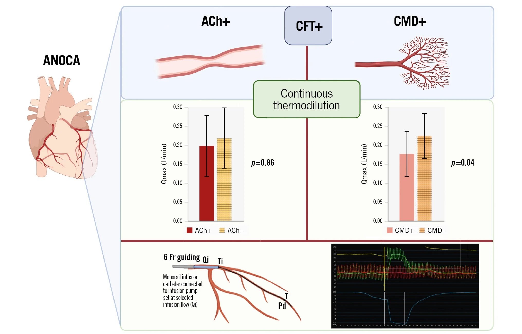 Continuous thermodilution and ANOCA endotypes