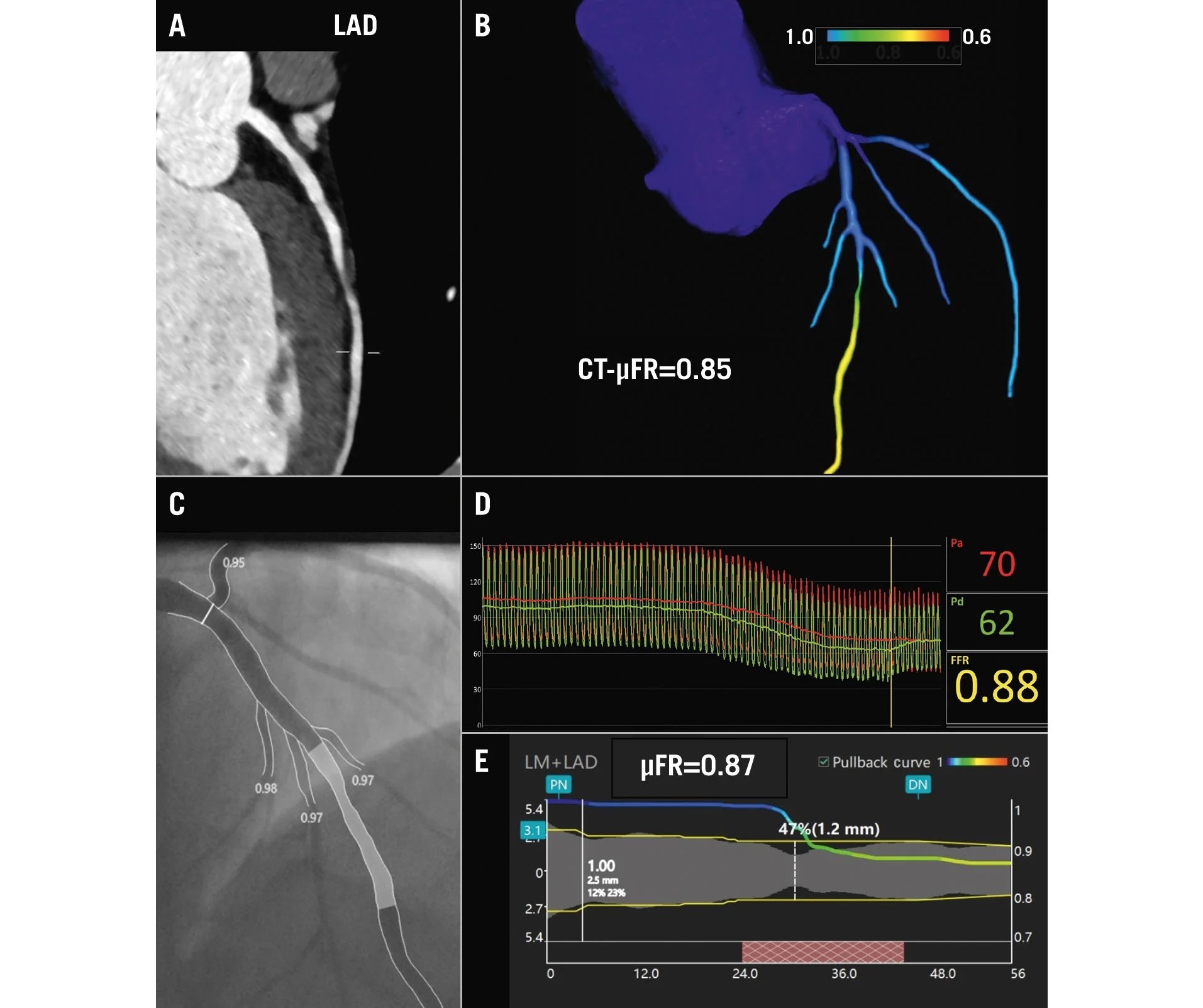 Accuracy of CT-μFR