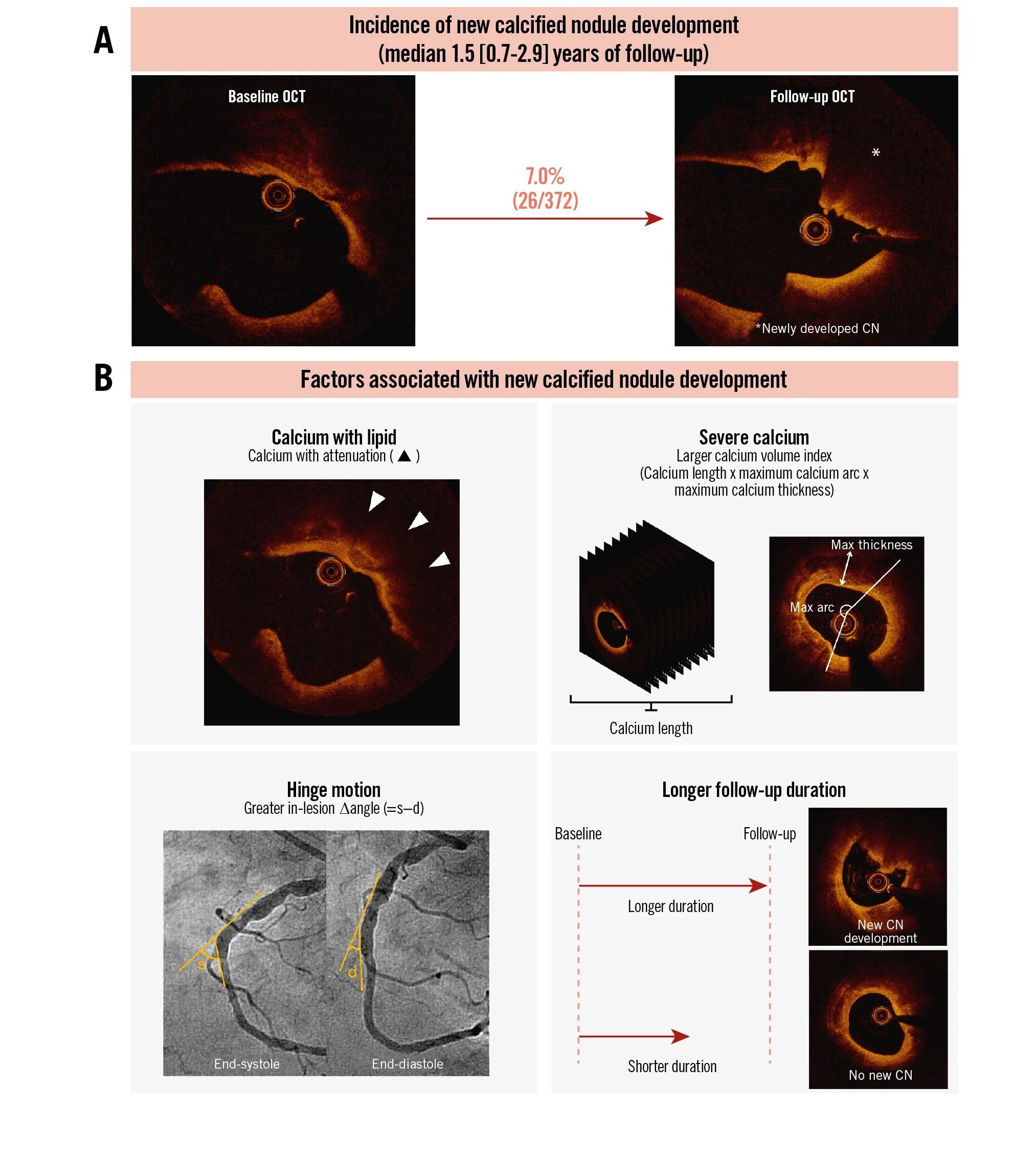 Natural history of a newly developed calcified nodule