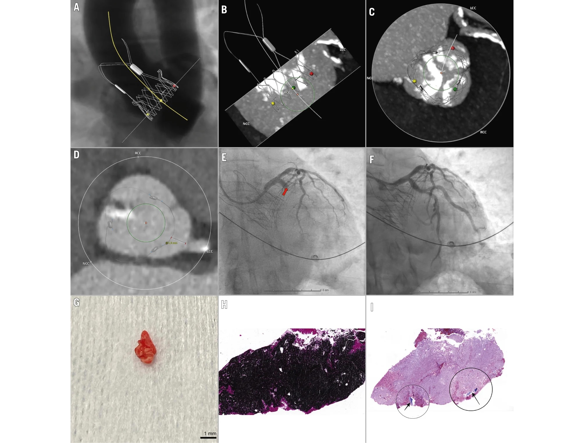 Late coronary embolism post-TAVI