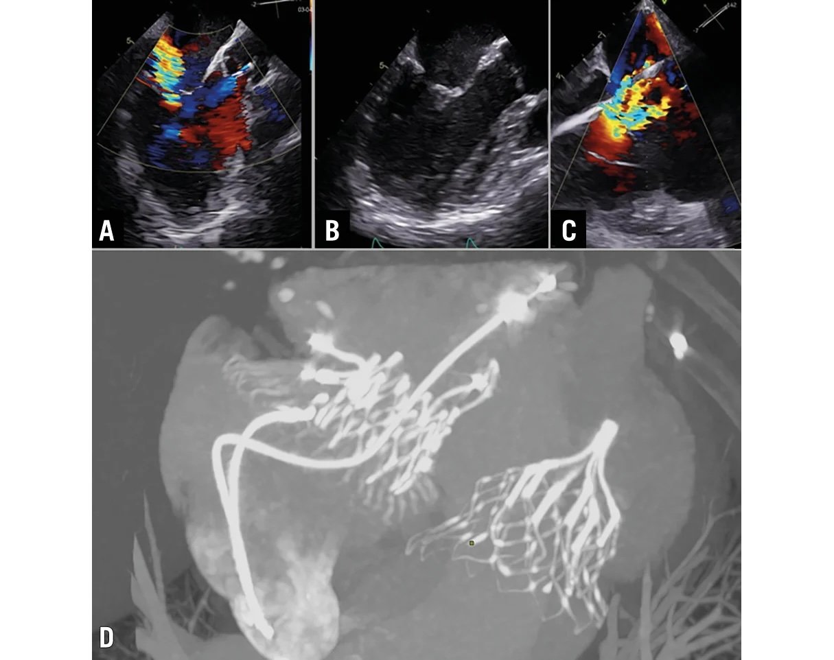 A double transcatheter valve replacement