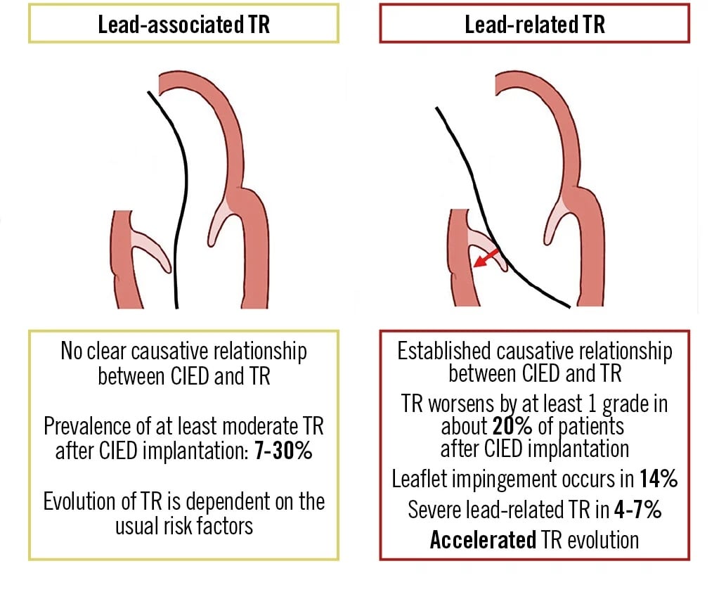 TR and leads