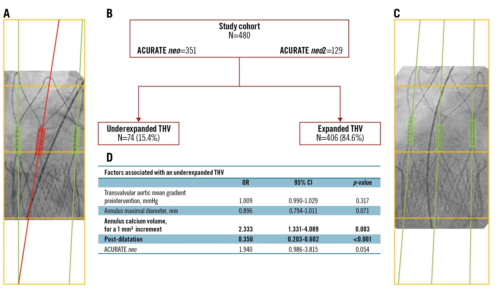 Predictors of underexpansion with ACURATE neo