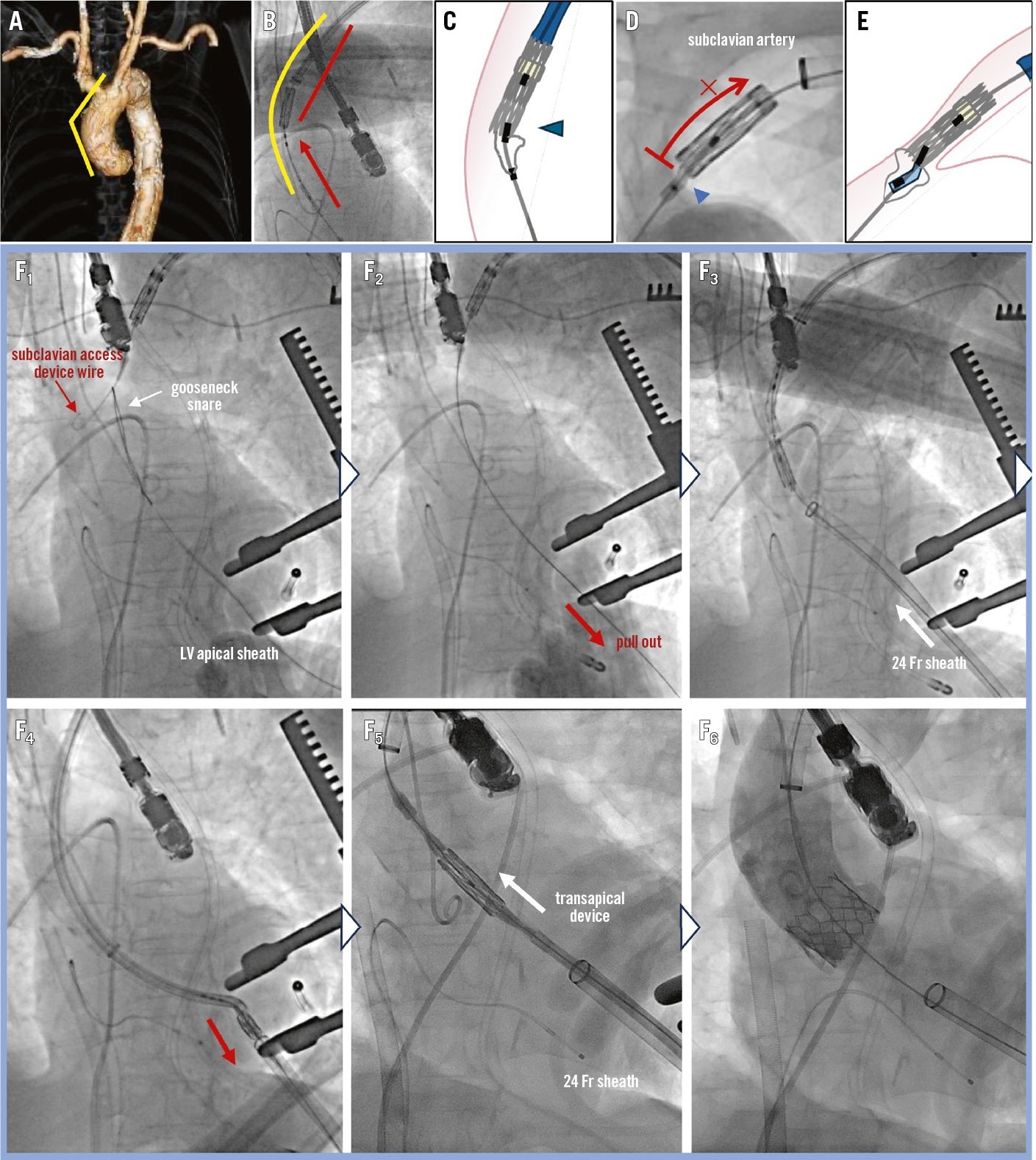 Retrieval of a stuck TAVI device