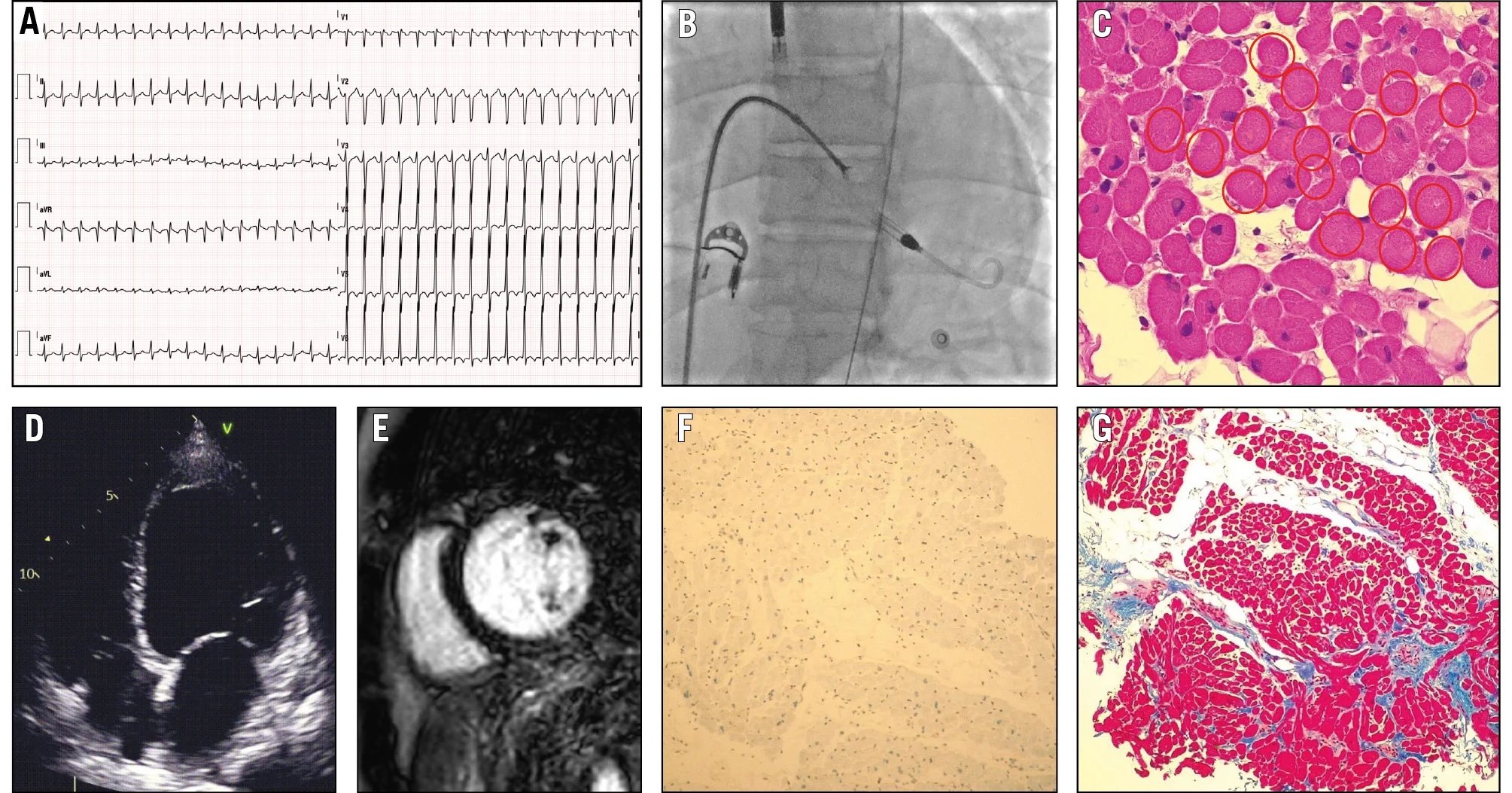 Endomyocardial biopsy