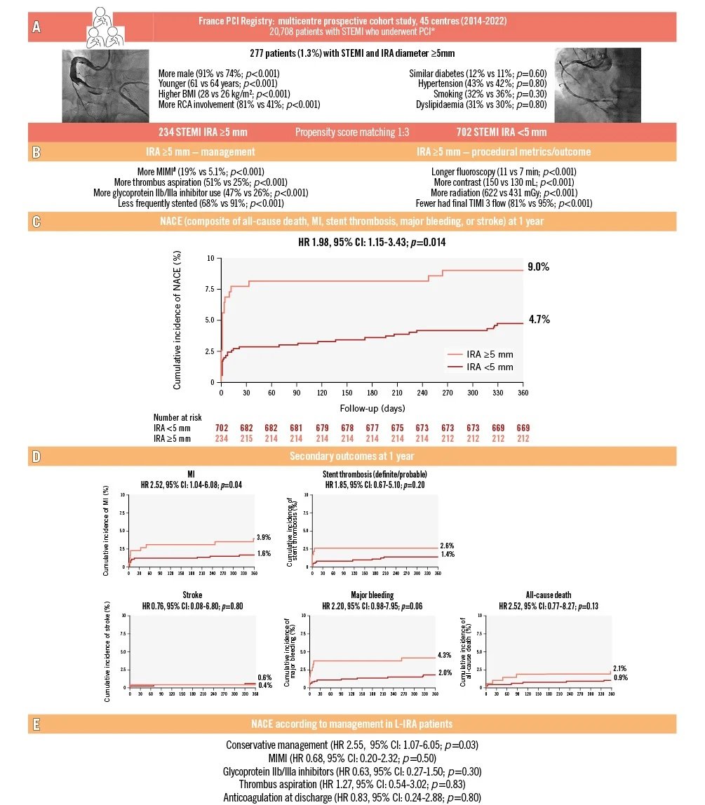 STEMI in large coronary arteries