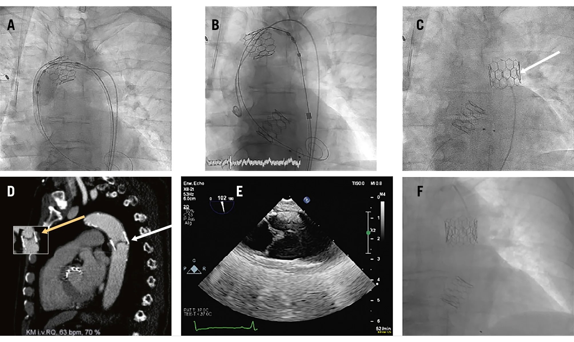 Paraplegia after TAVI