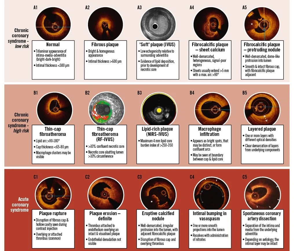Lesion stratification with IC imaging