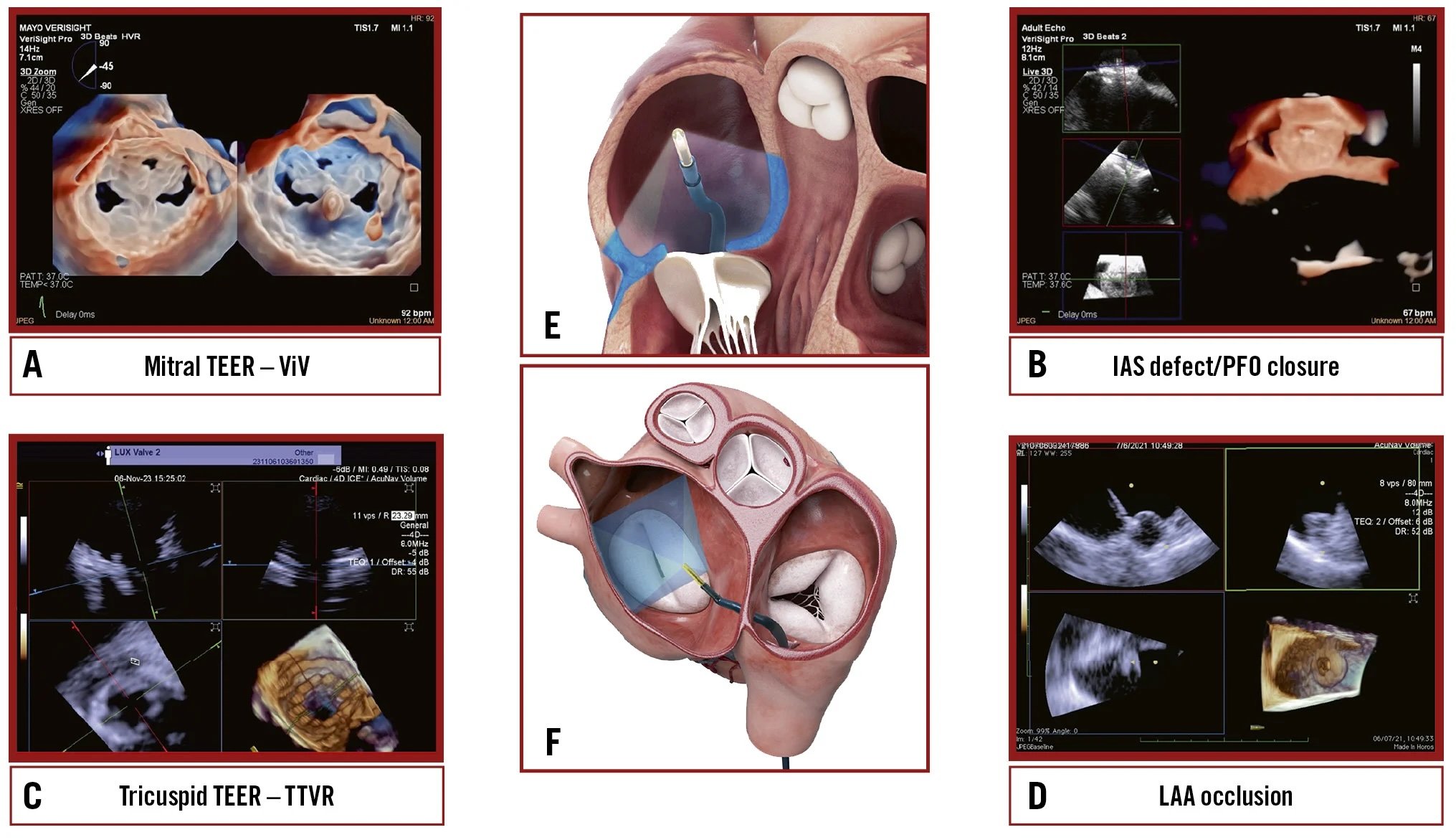 3D ICE in structural heart disease
