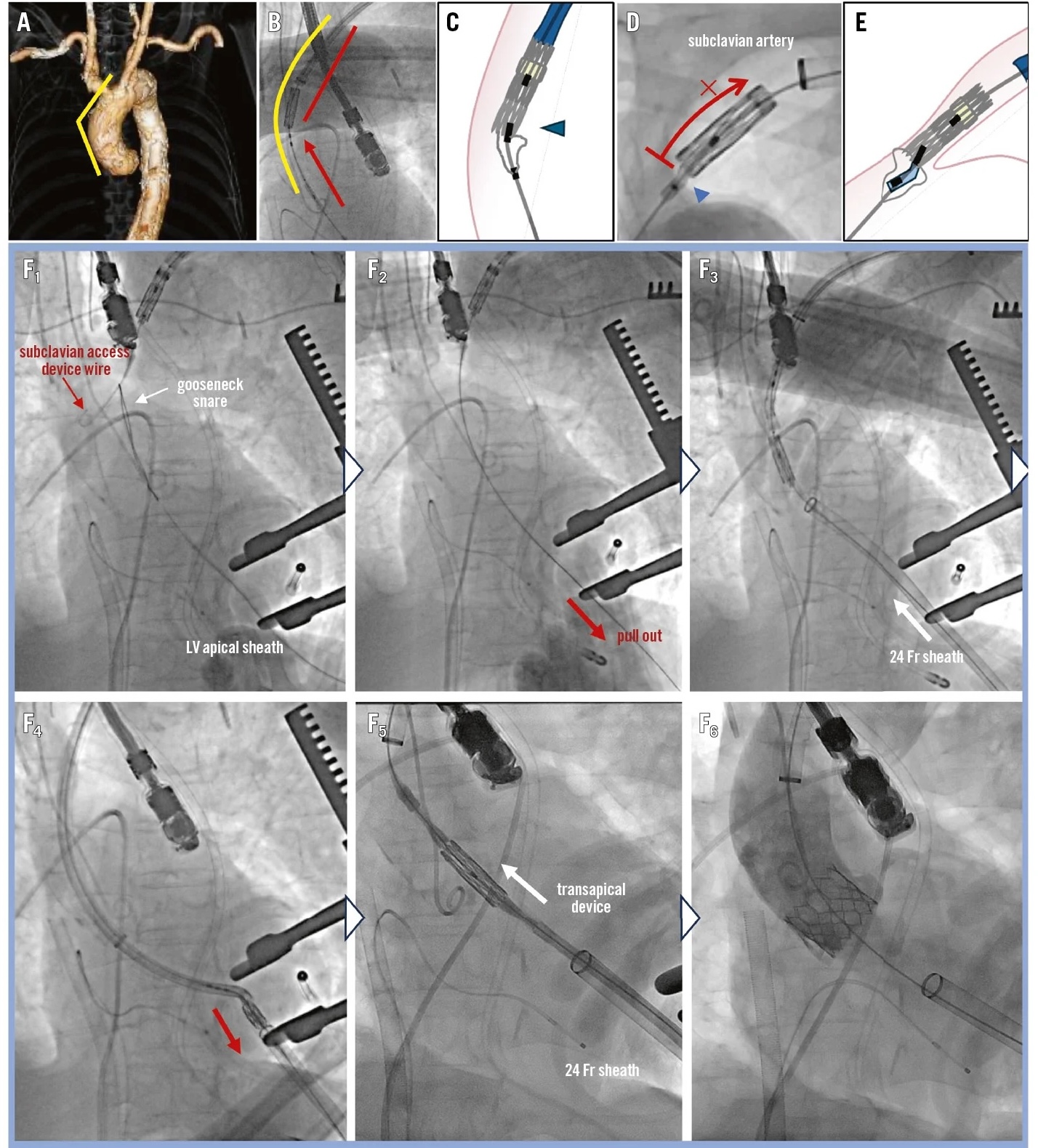 Retrieval of a stuck TAVI device