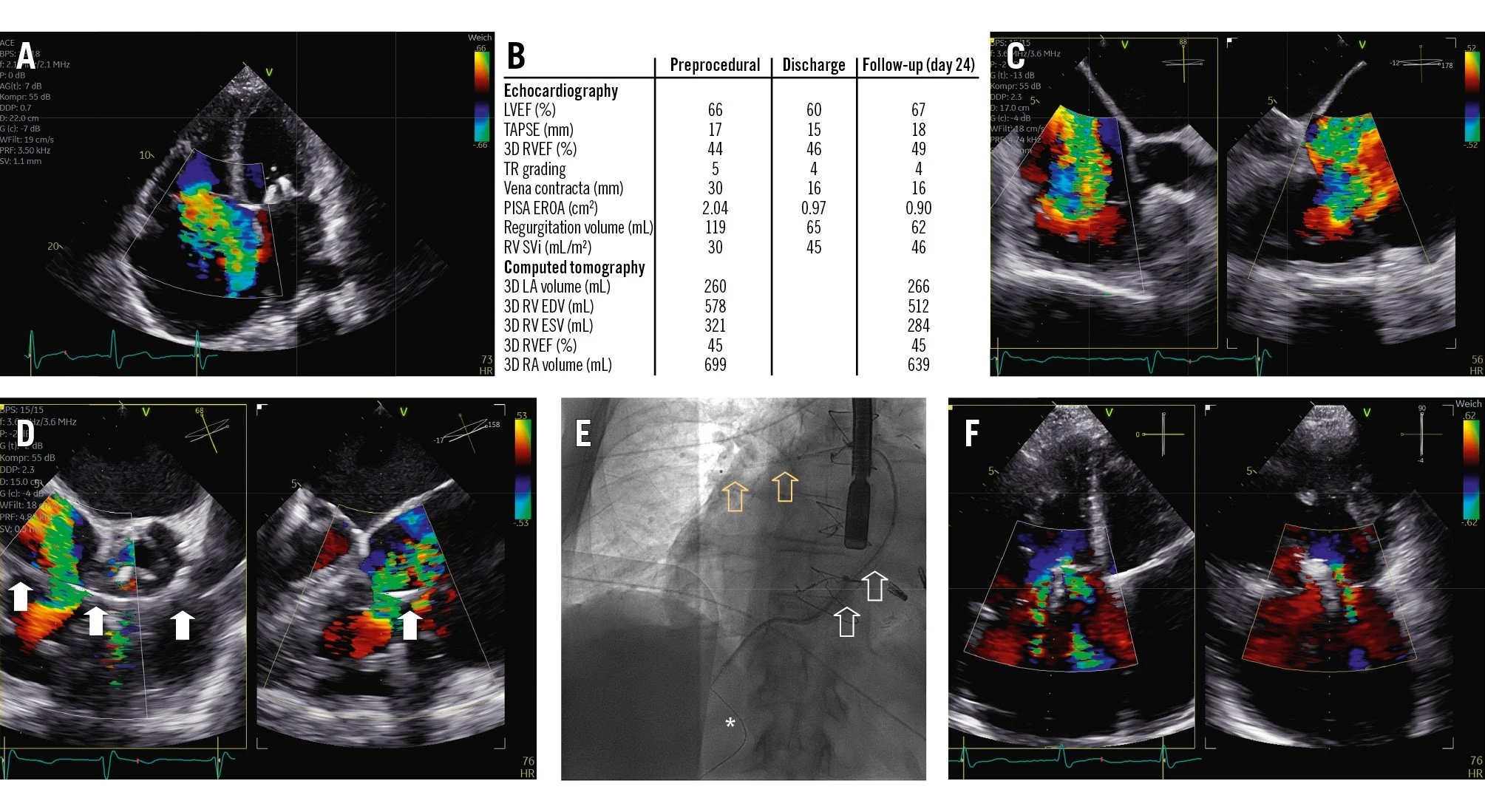 Novel transcatheter spacer for tricuspid regurgitation