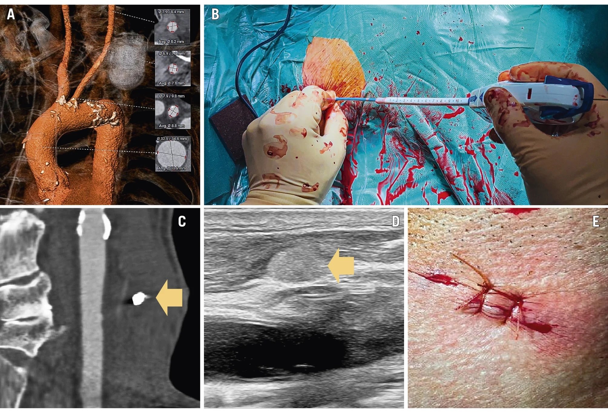 Percutaneous closure for transcarotid TAVI