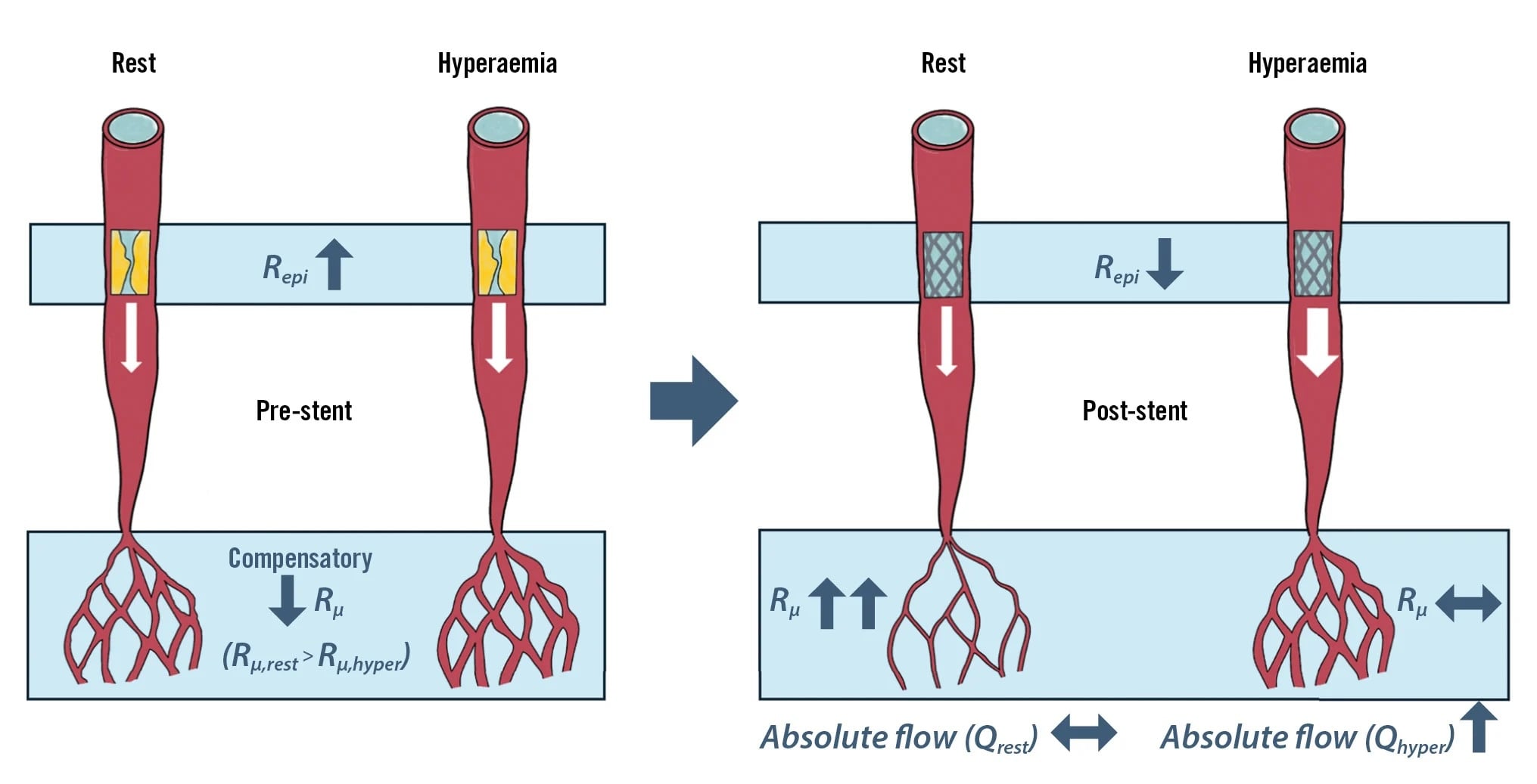 Absolute coronary flow after PCI