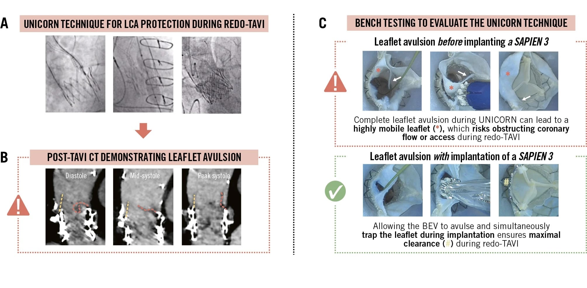 Leaflet avulsion after UNICORN