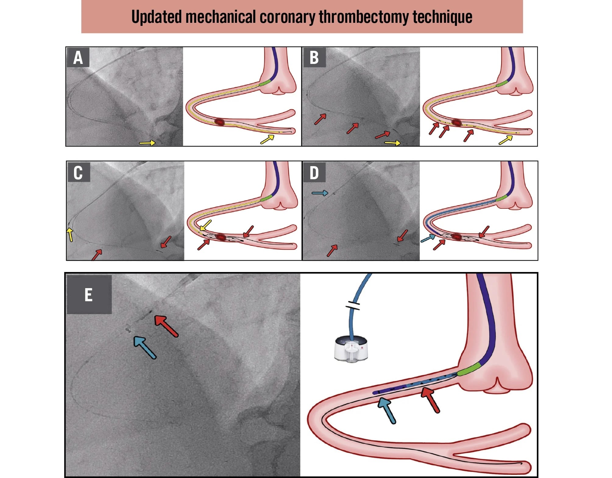 Updated coronary thrombectomy technique
