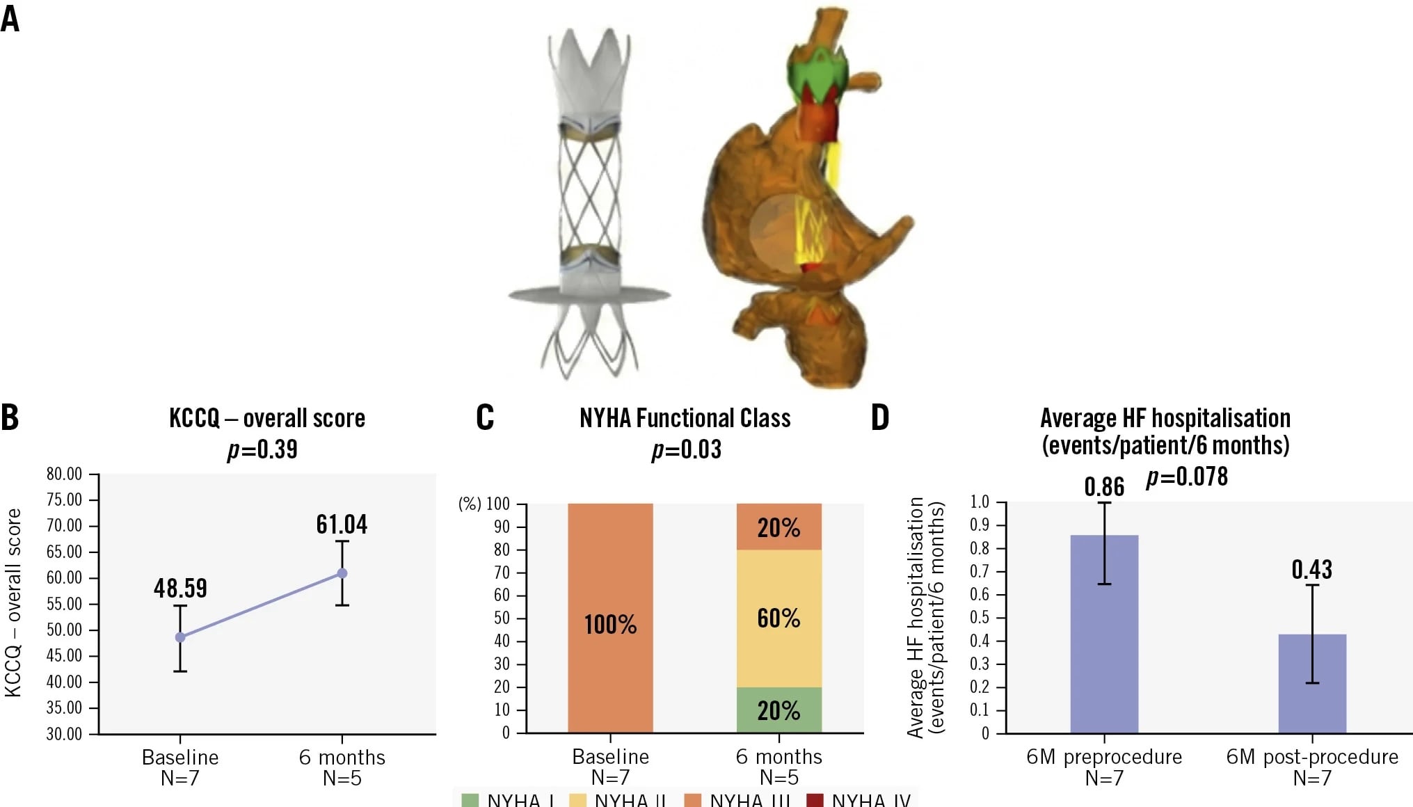 Unica for tricuspid regurgitation