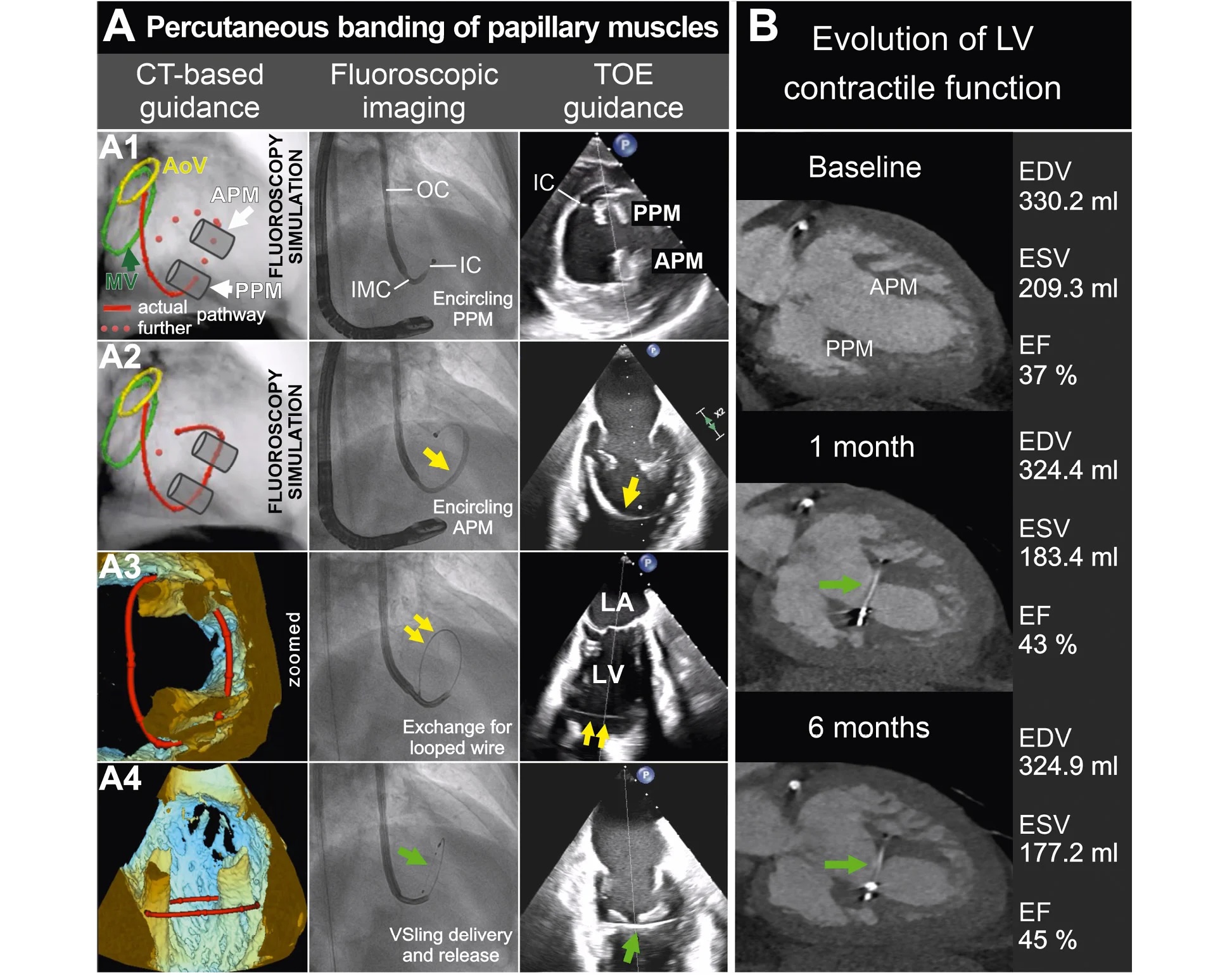 Transcatheter papillary muscle banding