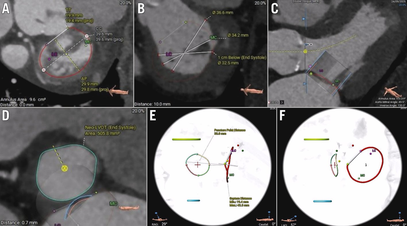 Concomitant transfemoral TAVI and TMVR