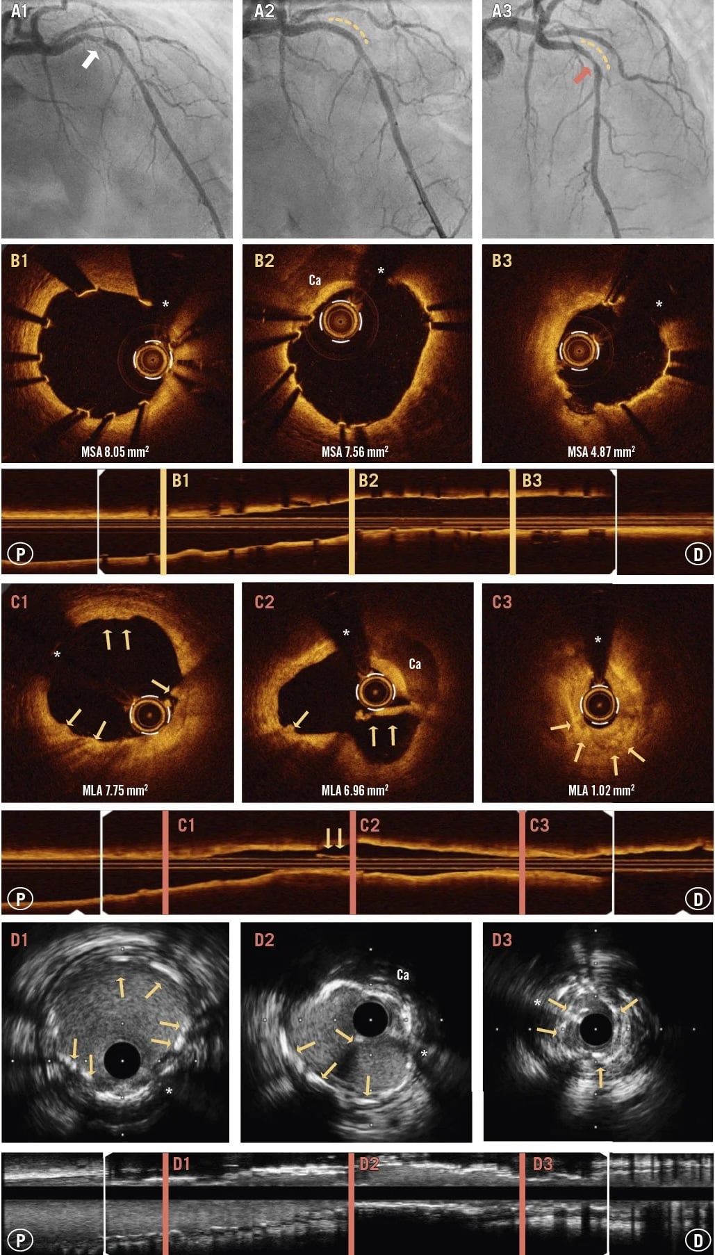 New-generation magnesium scaffold collapse